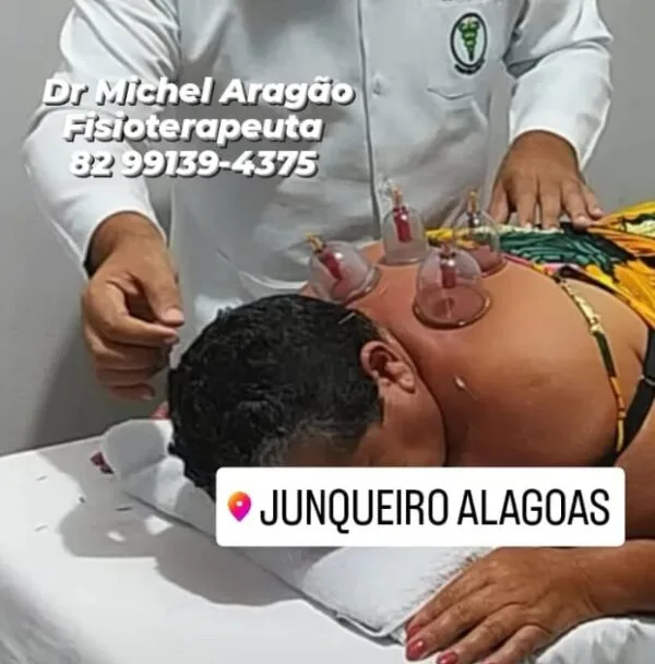 Paciente em sessão de ventosaterapia com Dr Michel Aragão para dor crônica na coluna em Junqueiro Alagoas